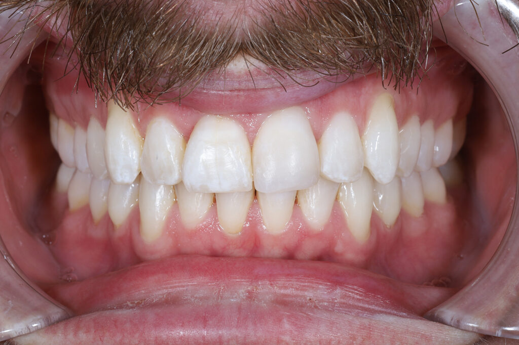 Teeth after whitening